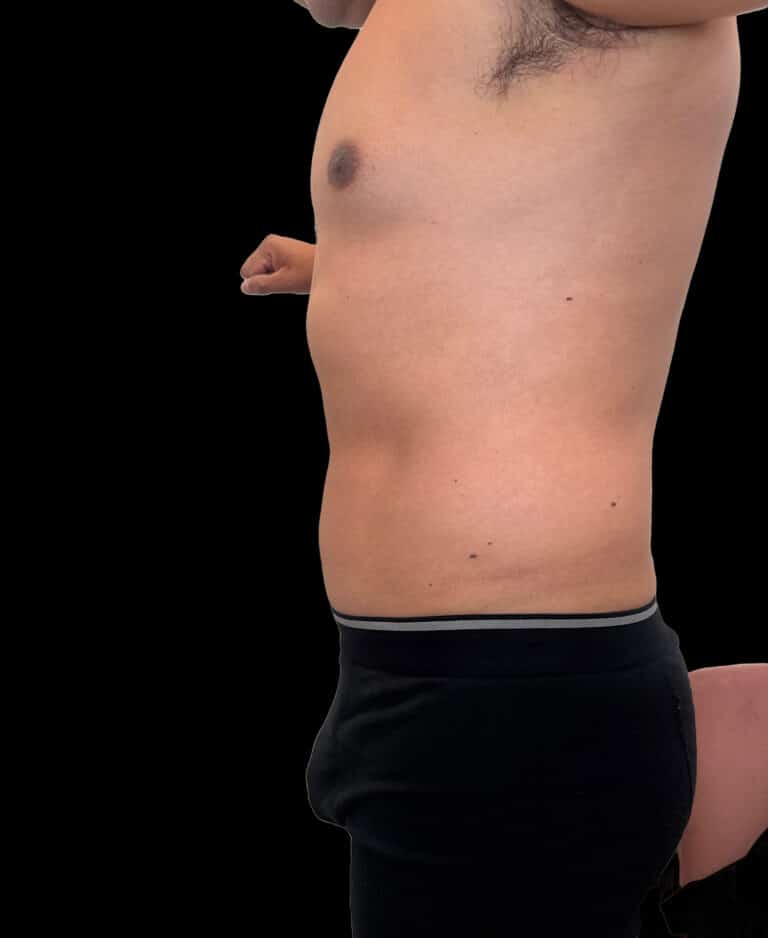 After Image: Case #9599 – Emsculpt Neo Abdomen - left-side