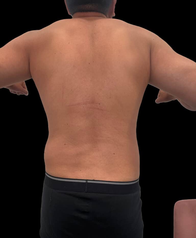 After Image: Case #9599 – Emsculpt Neo Abdomen - back