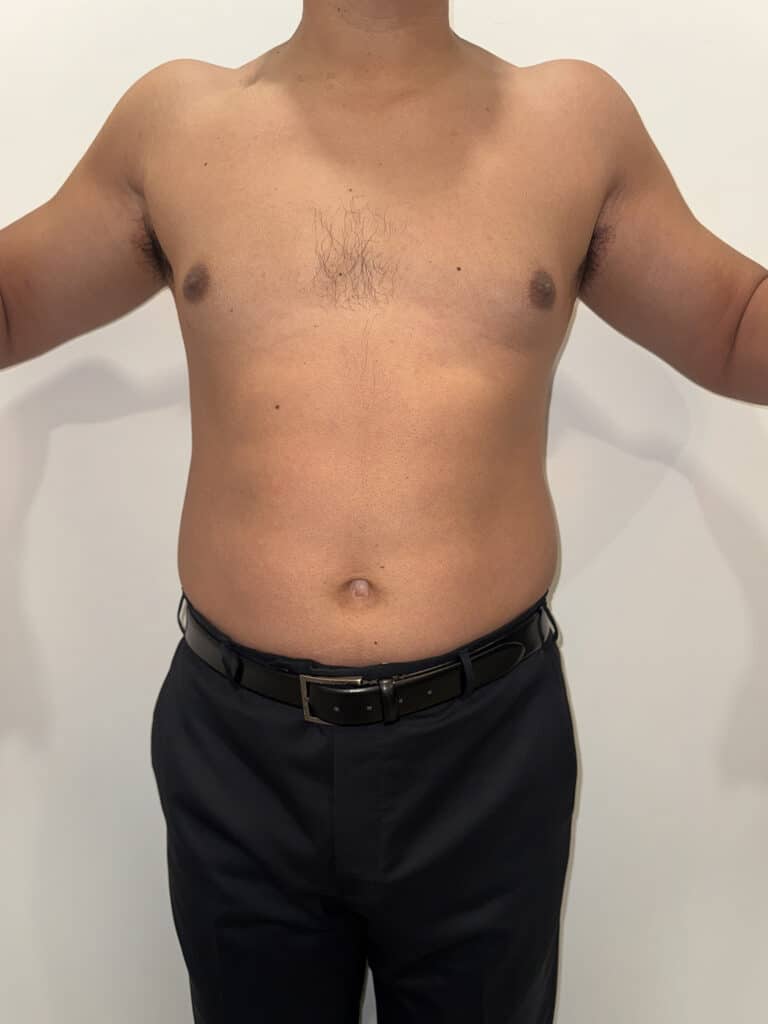 Before Image: Case #9599 – Emsculpt Neo Abdomen - front