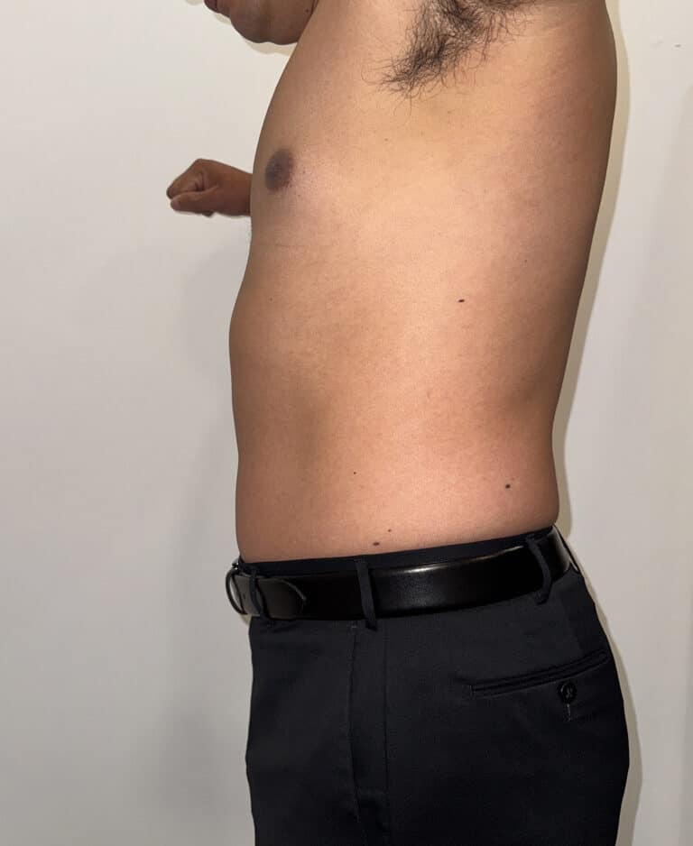 Before Image: Case #9599 – Emsculpt Neo Abdomen - left-side