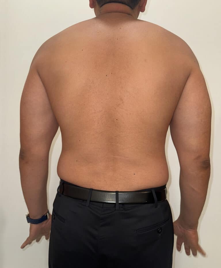Before Image: Case #9599 – Emsculpt Neo Abdomen - back