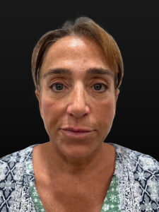 After Image: Case #9649 – Upper Blepharoplasty