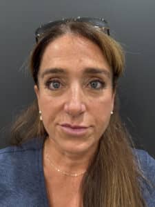 Before Image: Case #9649 – Upper Blepharoplasty