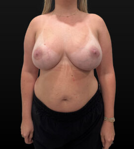 After Image: Breast Augmentation