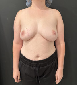 Before Image: Breast Augmentation