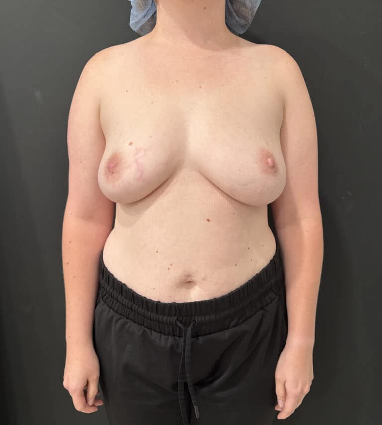 Before Image: Case #9624 – Breast Augmentation - front
