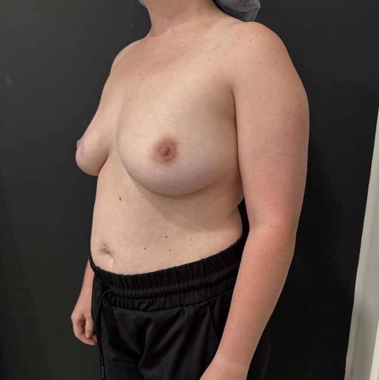 Before Image: Case #9624 – Breast Augmentation - left-front-oblique
