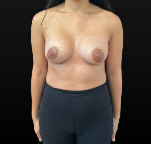 After Image: Case #9629 – Breast Augmentation