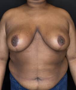 After Image: Case #9656 – Breast Reduction