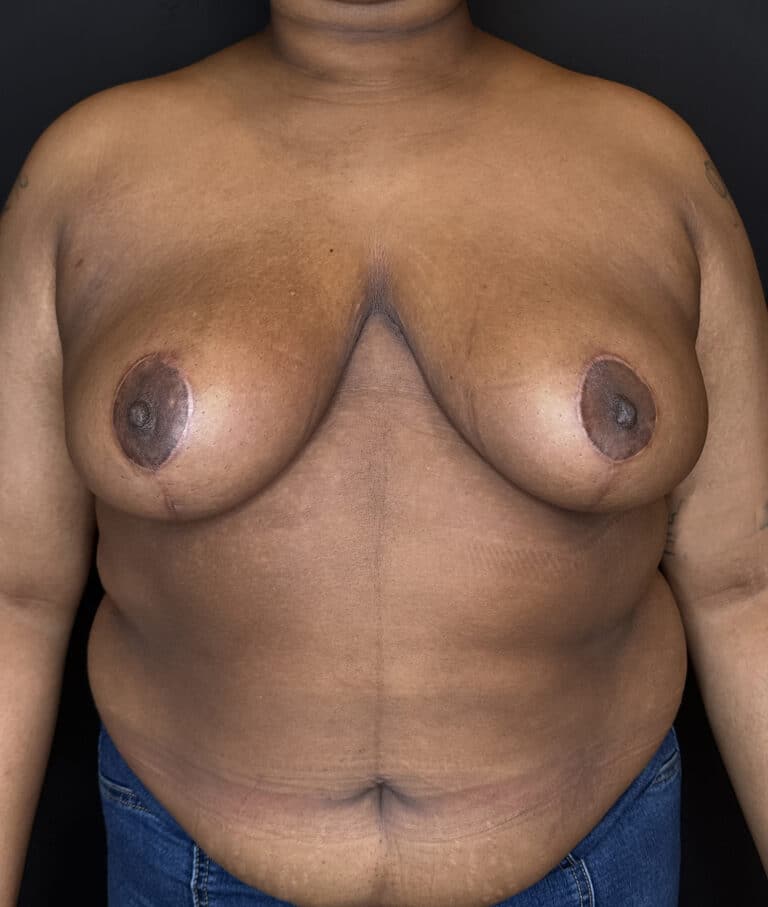 After Image: Case #9656 – Breast Reduction - front