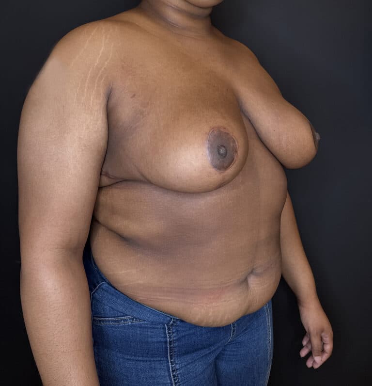 After Image: Case #9656 – Breast Reduction - right-front-oblique