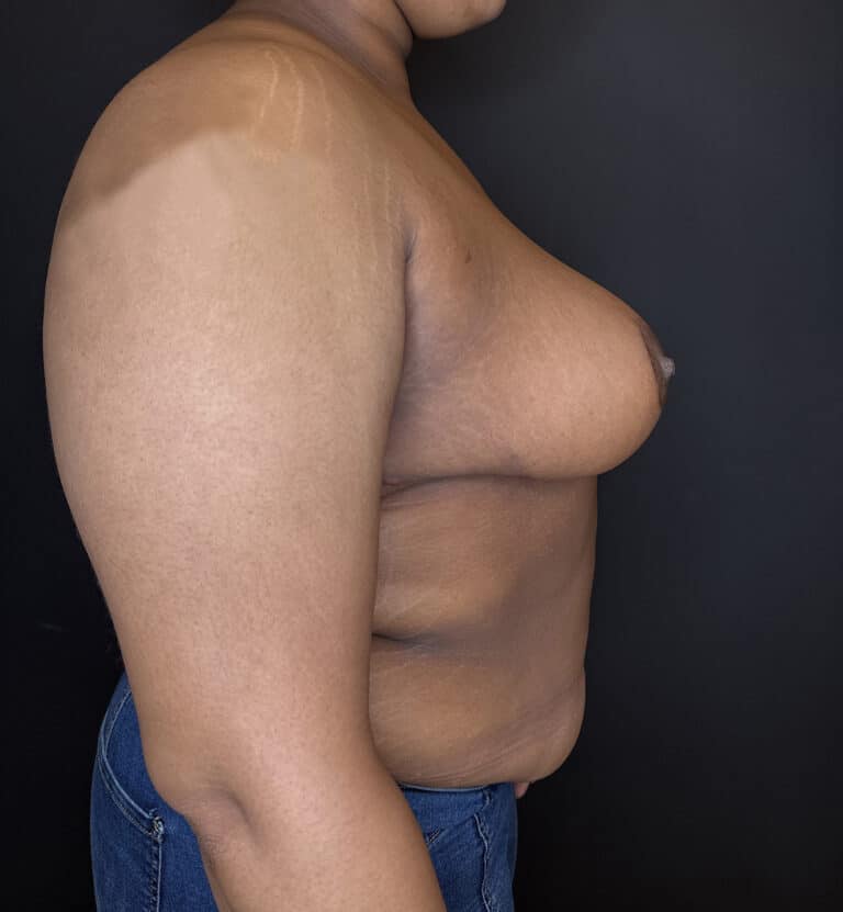After Image: Case #9656 – Breast Reduction - right-side