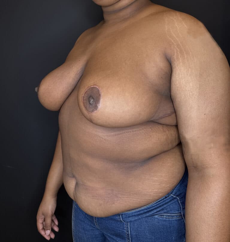 After Image: Case #9656 – Breast Reduction - left-front-oblique