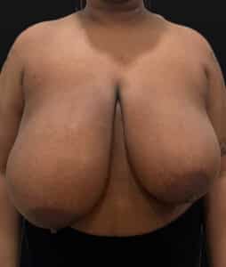 Before Image: Case #9656 – Breast Reduction