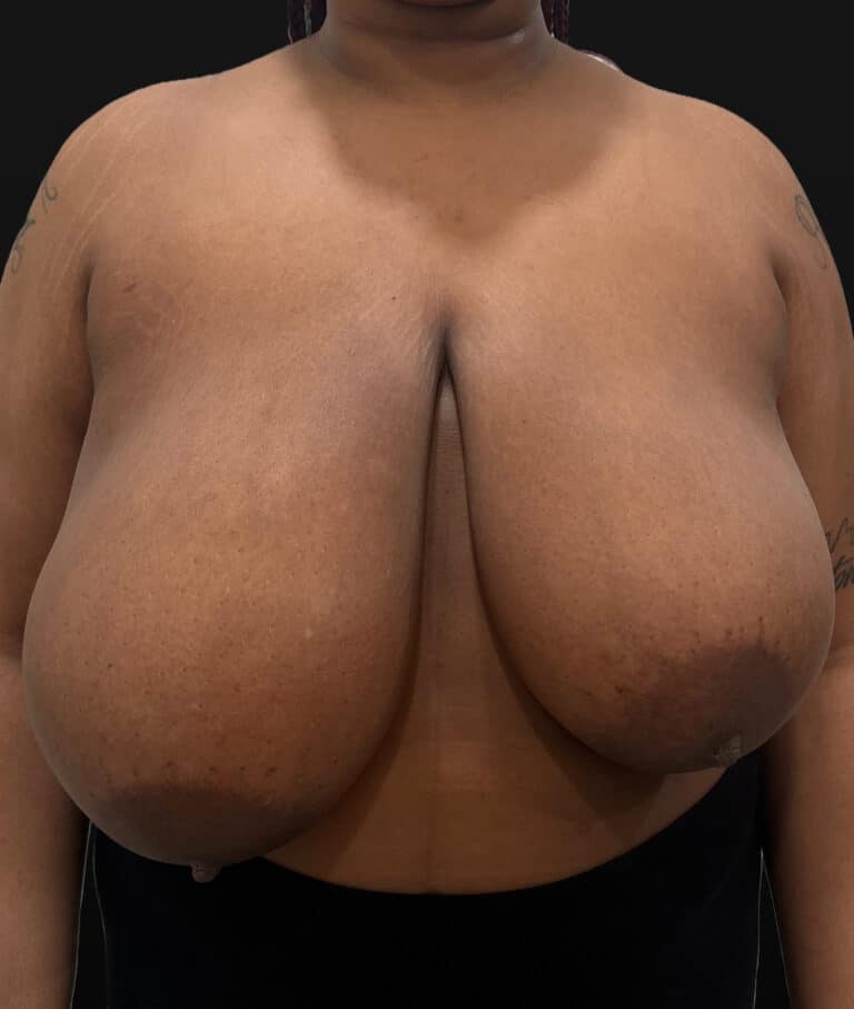 Before Image: Case #9656 – Breast Reduction - front