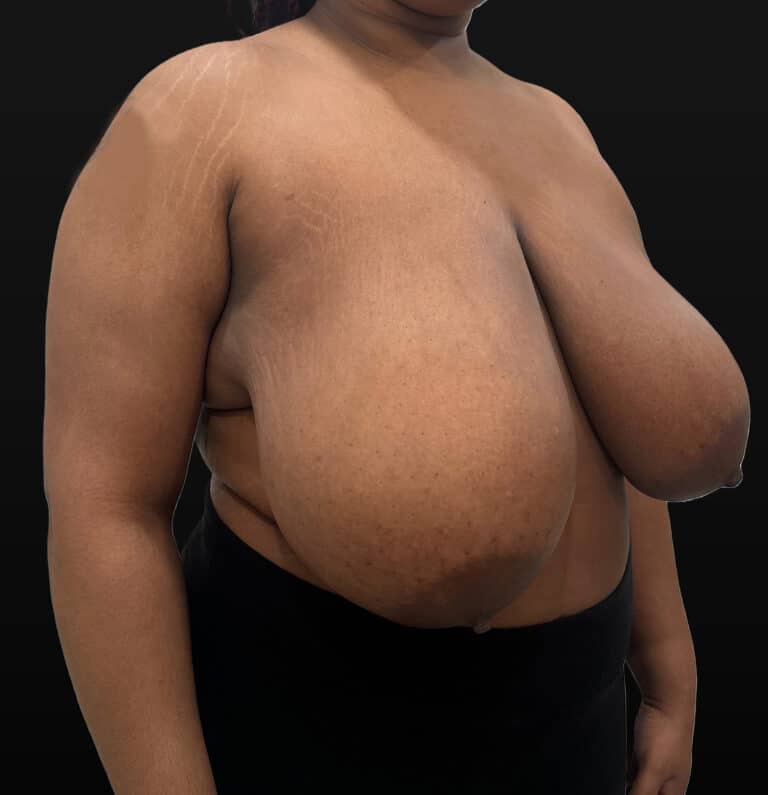 Before Image: Case #9656 – Breast Reduction - right-front-oblique