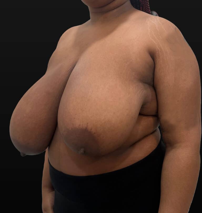 Before Image: Case #9656 – Breast Reduction - left-front-oblique