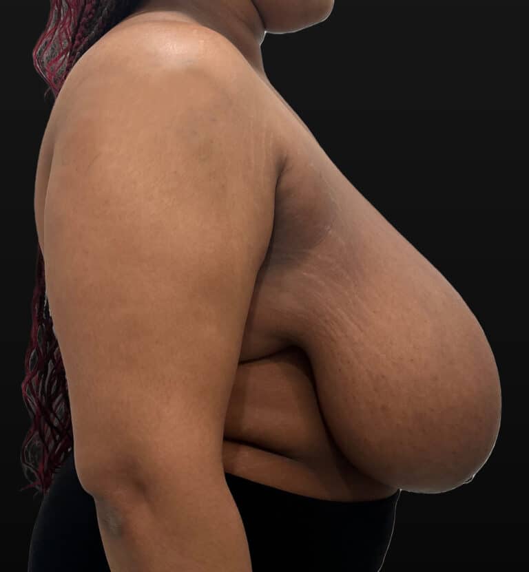 Before Image: Case #9656 – Breast Reduction - right-side