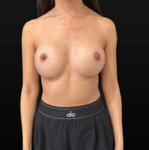 After Image: Case #9688 – Breast Augmentation