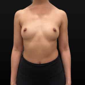 Before Image: Case #9688 – Breast Augmentation