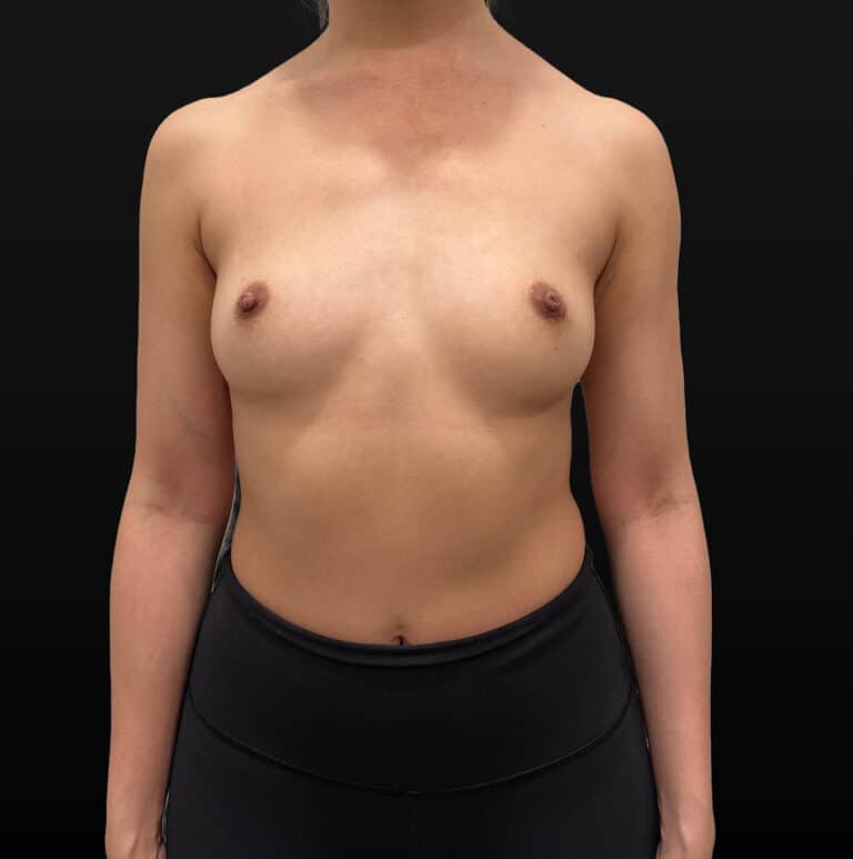 Before Image: Case #9688 – Breast Augmentation - front