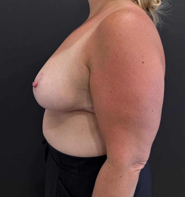After Image: Case #9695 – Breast Reduction - left-side
