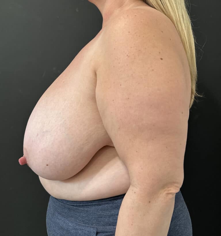 Before Image: Case #9695 – Breast Reduction - left-side