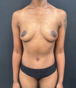 After Image: Case #9700 – Mommy Makeover