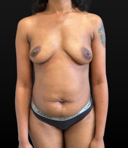 Before Image: Case #9700 – Mommy Makeover