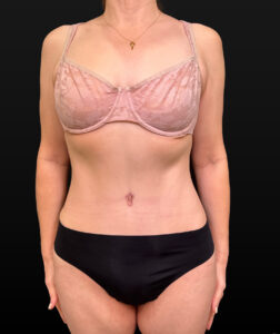 After Image: Case #9707 – Abdominoplasty