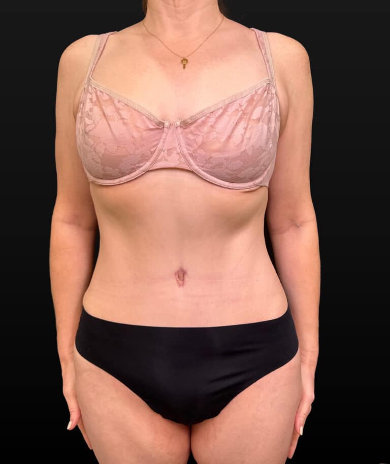 After Image: Case #9707 – Abdominoplasty - front