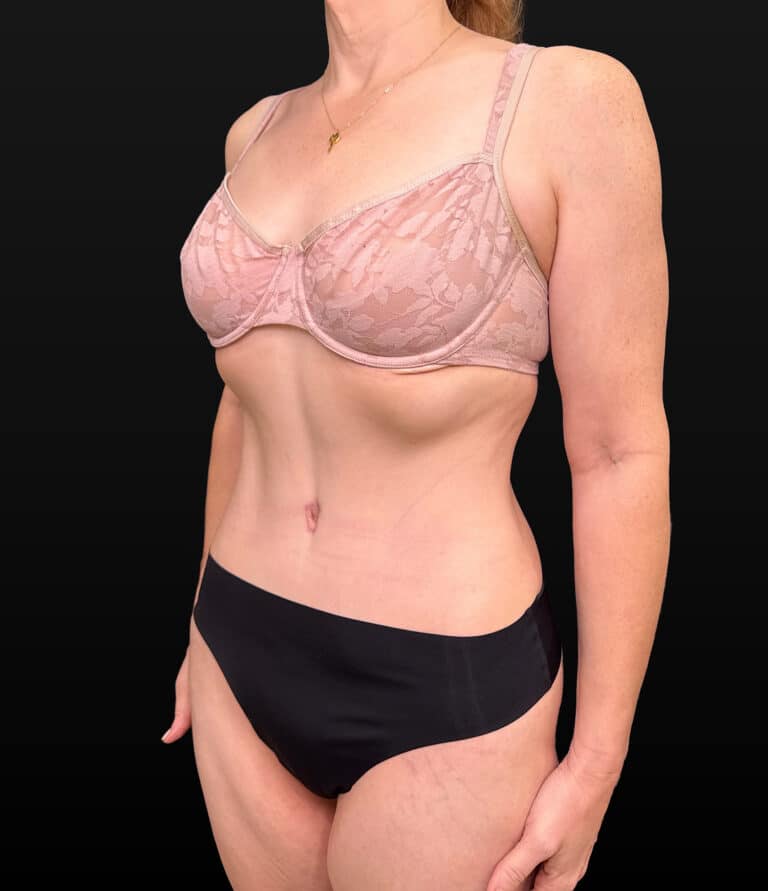 After Image: Case #9707 – Abdominoplasty - left-front-oblique