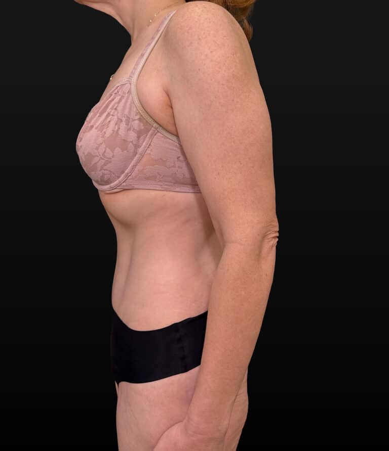 After Image: Case #9707 – Abdominoplasty - left-side