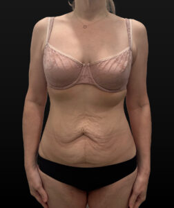 Before Image: Case #9707 – Abdominoplasty