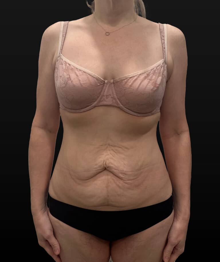 Before Image: Case #9707 – Abdominoplasty - front