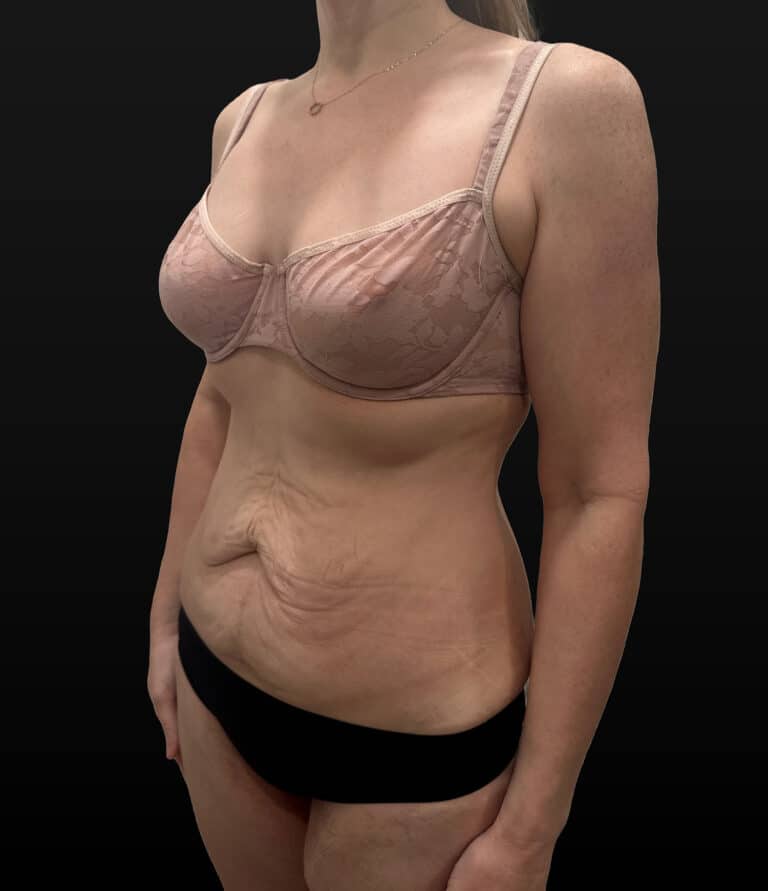 Before Image: Case #9707 – Abdominoplasty - left-front-oblique