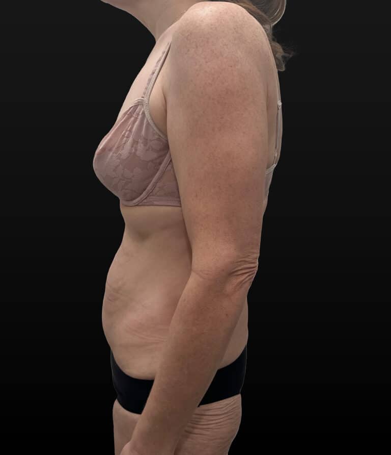 Before Image: Case #9707 – Abdominoplasty - left-side