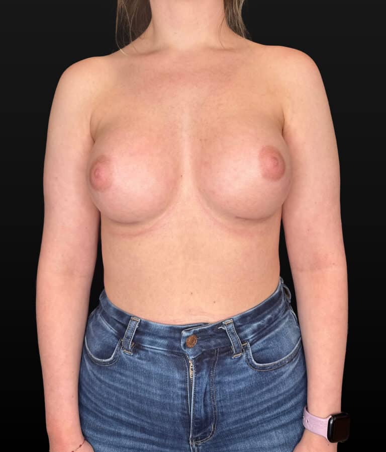 After Image: Case #10170 – Breast Augmentation - front