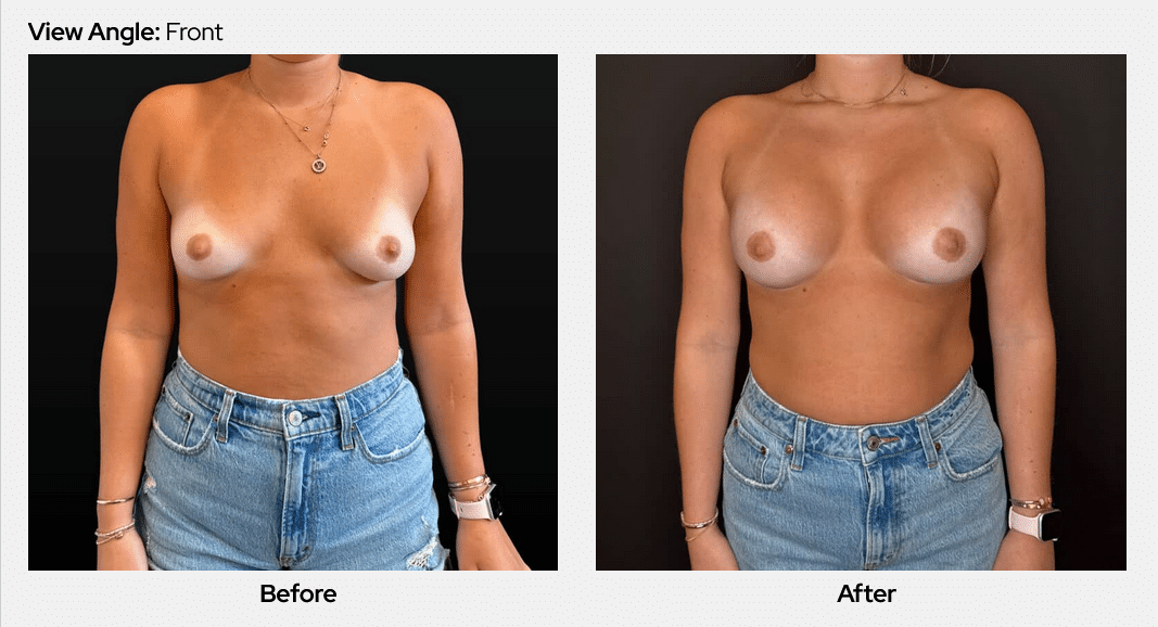 128891 Breast Aug 3 month Post op