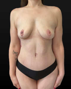 After Image: Case #10206 – Mommy Makeover