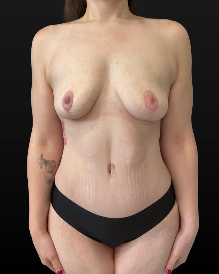 After Image: Case #10206 – Mommy Makeover - front