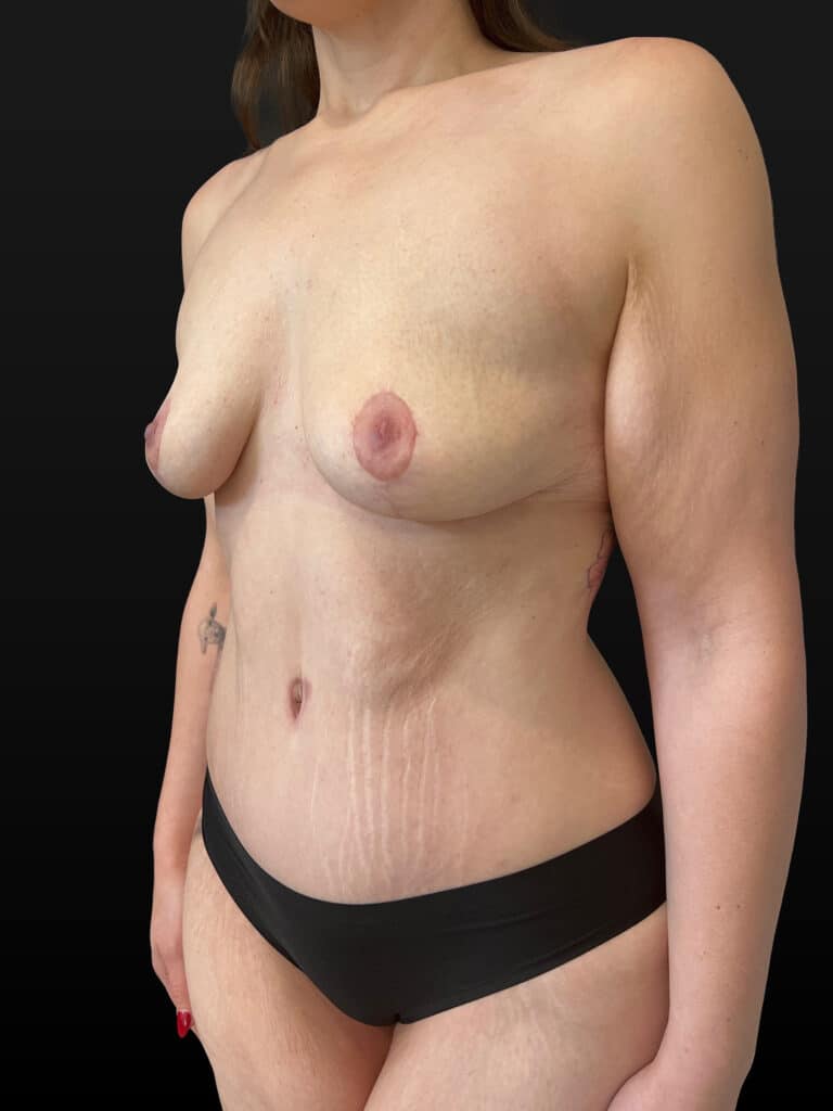 After Image: Case #10206 – Mommy Makeover - left-front-oblique