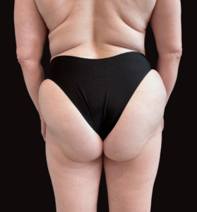 After Image: Case #10232 – Body Contour, Emsculpt Neo Glutes