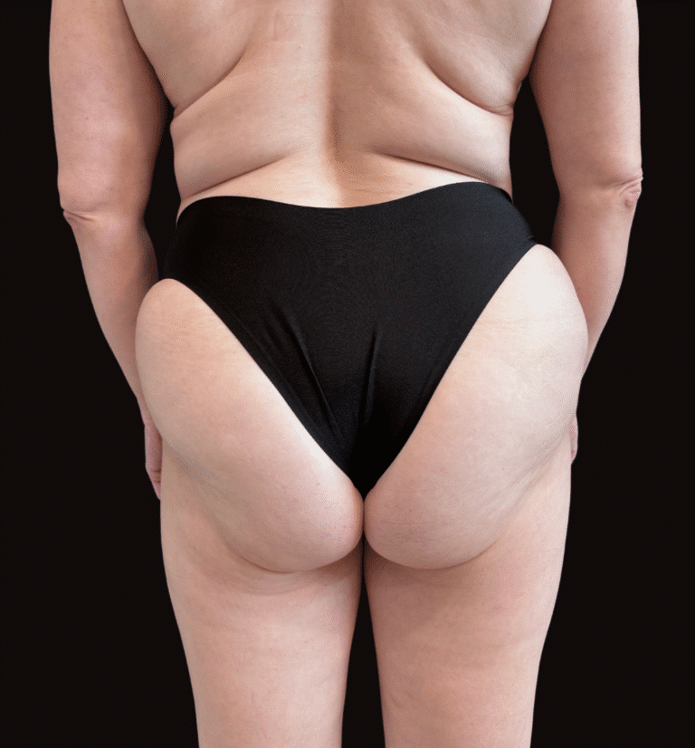After Image: Case #10232 – Body Contour, Emsculpt Neo Glutes - back