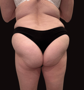 Before Image: Case #10232 – Body Contour, Emsculpt Neo Glutes