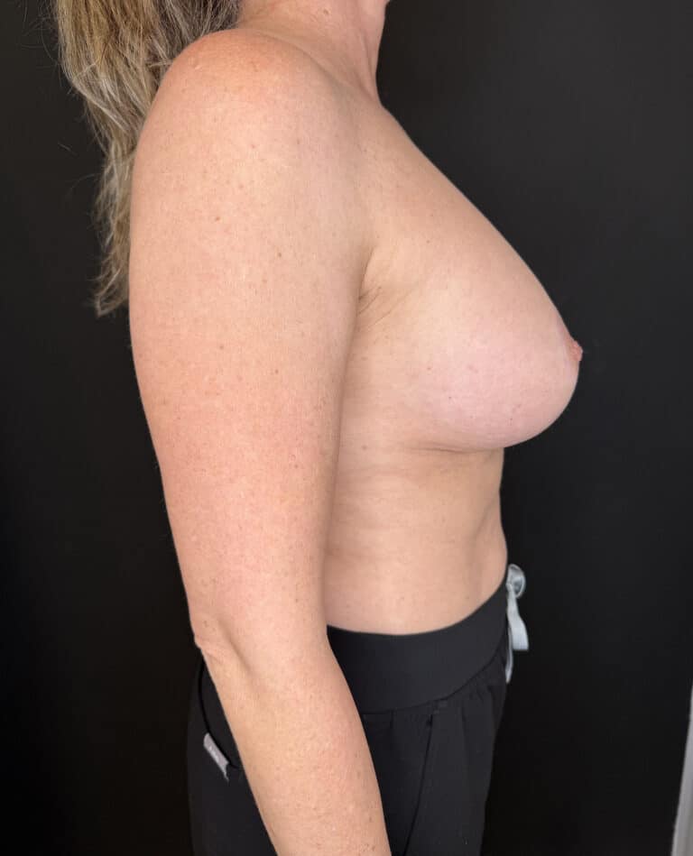 After Image: Case #10221 – Breast Lift with Augmentation - right-side