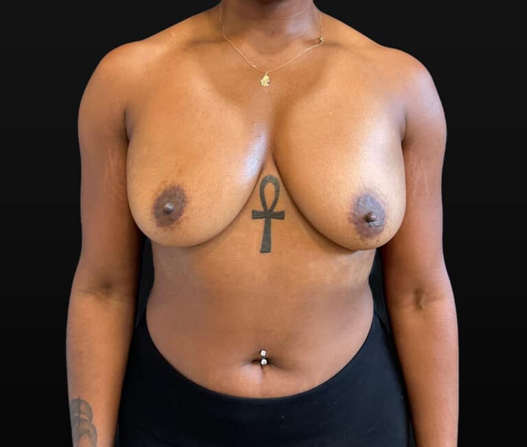 Before Image: Case #10262 – Breast Augmentation - front