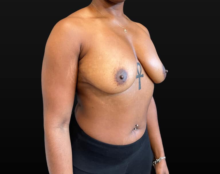 Before Image: Case #10262 – Breast Augmentation - right-front-oblique
