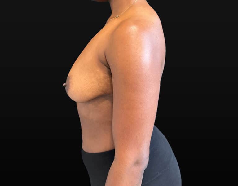 Before Image: Case #10262 – Breast Augmentation - left-side