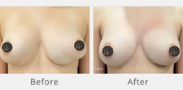 Breast Revision